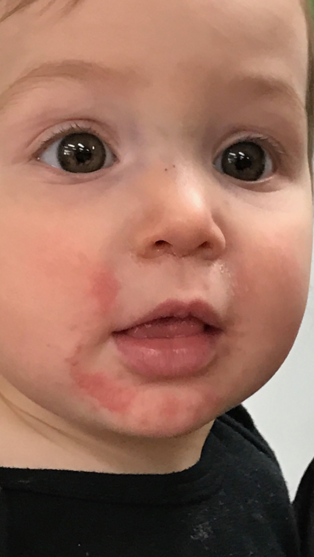 Baby has rash around mouth after eating